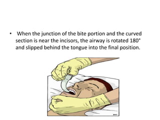 • When the junction of the bite portion and the curved
section is near the incisors, the airway is rotated 180°
and slipped behind the tongue into the final position.
 