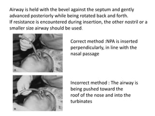 Correct method :NPA is inserted
perpendicularly, in line with the
nasal passage
Incorrect method : The airway is
being pushed toward the
roof of the nose and into the
turbinates
Airway is held with the bevel against the septum and gently
advanced posteriorly while being rotated back and forth.
If resistance is encountered during insertion, the other nostril or a
smaller size airway should be used.
 