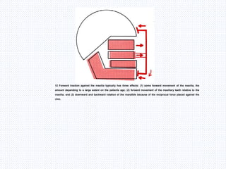 12 Forward traction against the maxilla typically has three effects: (1) some forward movement of the maxilla, the
amount depending to a large extent on the patients age; (2) forward movement of the maxillary teeth relative to the
maxilla; and (3) downward and backward rotation of the mandible because of the reciprocal force placed against the
chin.
 