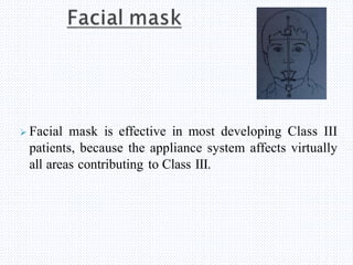  Facial mask is effective in most developing Class III
patients, because the appliance system affects virtually
all areas contributing to Class III.
 