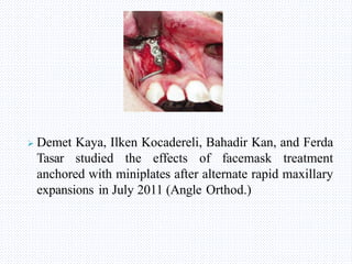  Demet Kaya, Ilken Kocadereli, Bahadir Kan, and Ferda
Tasar studied the effects of facemask treatment
anchored with miniplates after alternate rapid maxillary
expansions in July 2011 (Angle Orthod.)
 