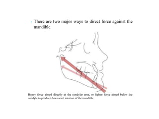 ⦁ There are two major ways to direct force against the
mandible.
Heavy force aimed directly at the condylar area, or lighter force aimed below the
condyle to produce downward rotation of the mandible.
 