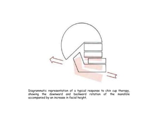 Diagrammatic representation of a typical response to chin cup therapy,
showing the downward and backward rotation of the mandible
accompanied by an increase in facial height.
 