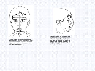 . Frontal view of the Petit facial mask. Note
that the elastics converge on and attach to the
crossbow immediately adjacent to the central
support bar. The positions of the forehead &
chin pads are adjustable
The lateral view of the orthopedic facial
mask. Note the downward direction of
pull of the elastics. The direction of the
pull can be adjusted by raising or
lowering the crossbar, however, the
elastics must not interfere with the
functional of the lips.
 