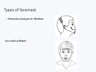 Types of facemask
• Protraction head gear by 'Hickham
Face mask of Delaire
 