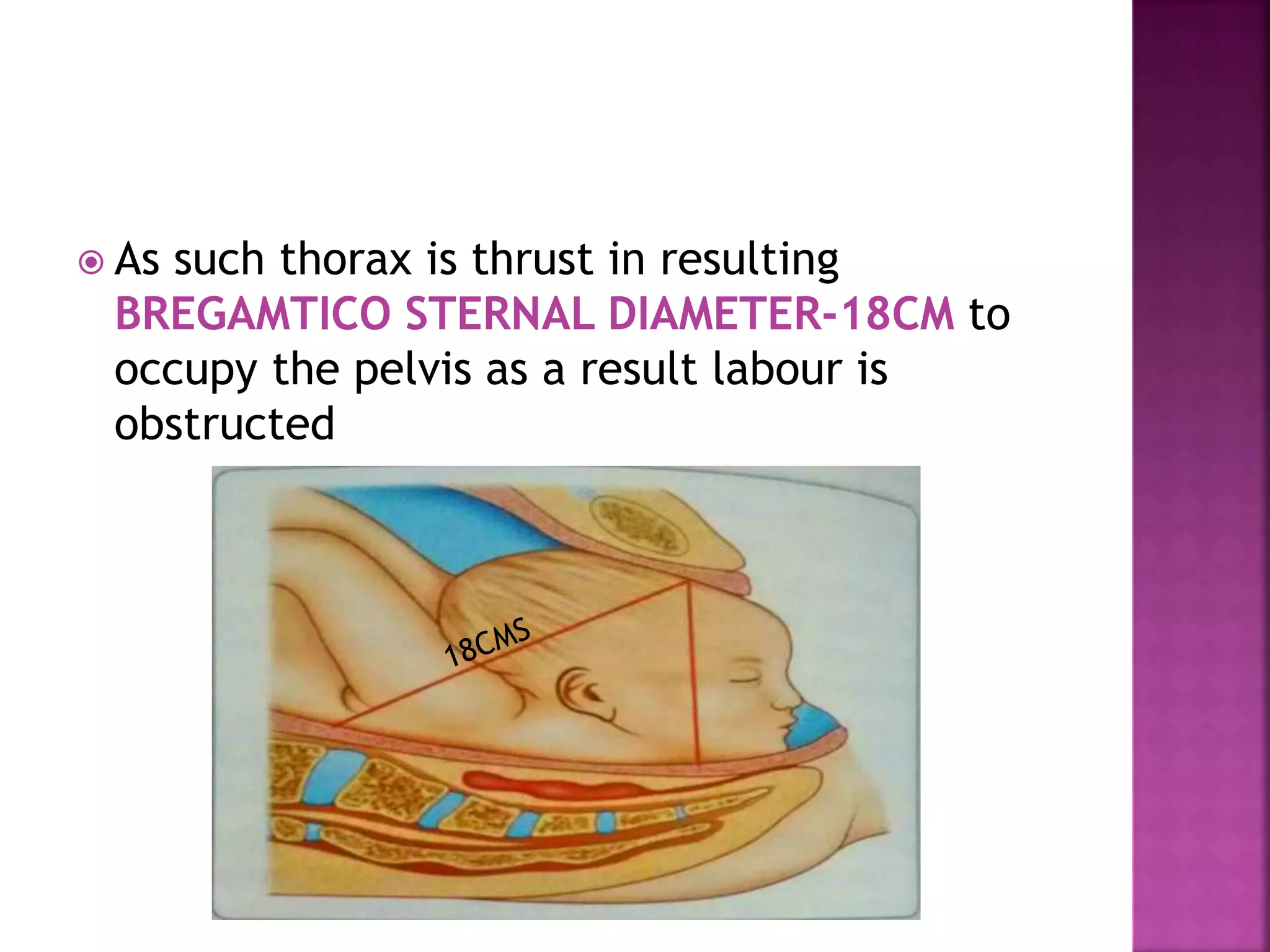  As such thorax is thrust in resulting
BREGAMTICO STERNAL DIAMETER-18CM to
occupy the pelvis as a result labour is
obstructed
 