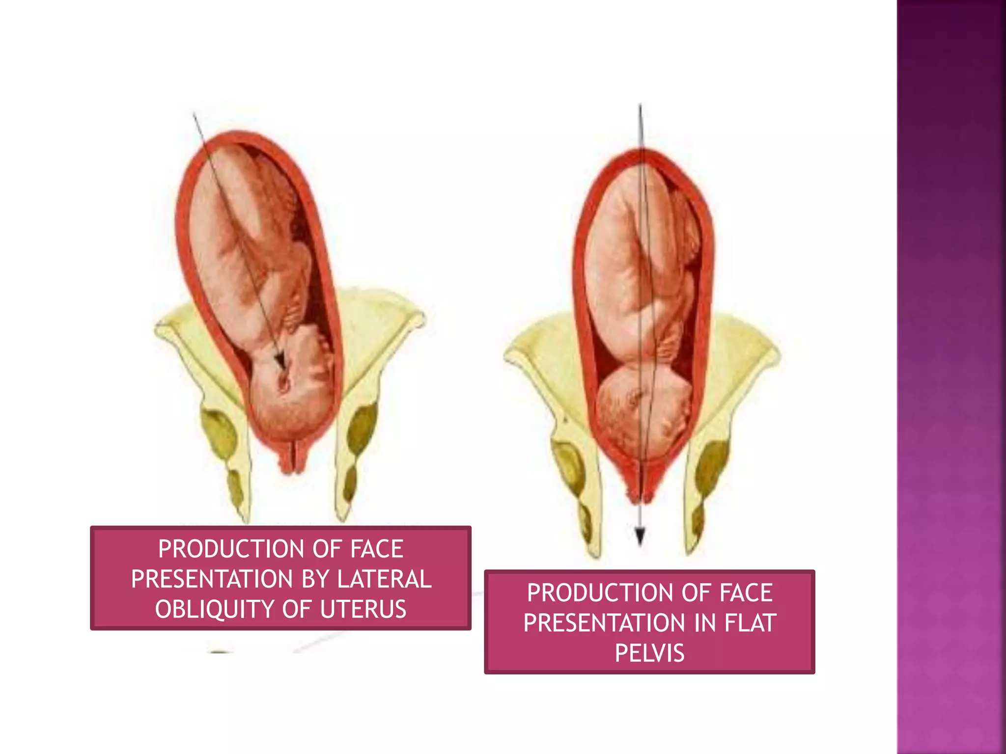 PRODUCTION OF FACE
PRESENTATION BY LATERAL
OBLIQUITY OF UTERUS
PRODUCTION OF FACE
PRESENTATION IN FLAT
PELVIS
 