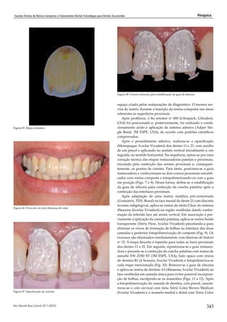Facetas diretas de resina composta e clareamento dental | PDF