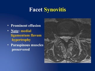 Paraspinous Injection facetjointinjectioncomments-191123152135.pptx
