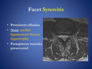 Facet Synovitis
• Prominent effusion
• Note: medial
ligamentum flavum
hypertrophy
• Paraspinous muscles
preservered
 