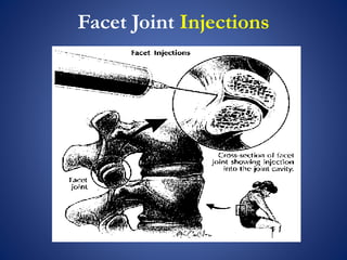 Facet Joint Injections
 