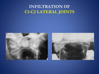 INFILTRATION OF
C1-C2 LATERAL JOINTS
 