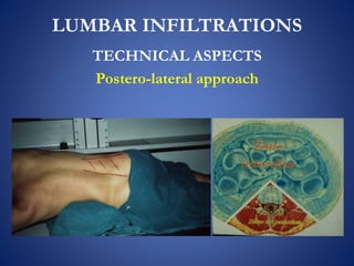 LUMBAR INFILTRATIONS
TECHNICAL ASPECTS
Postero-lateral approach
 