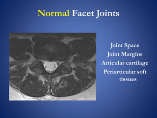 Normal Facet Joints
Joint Space
Joint Margins
Articular cartilage
Periarticular soft
tissues
 