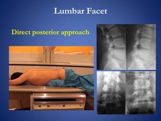 Lumbar Facet
Direct posterior approach
 