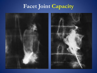 Facet Joint Capacity
 