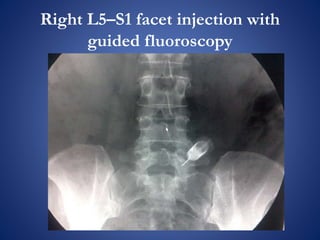 Right L5–S1 facet injection with
guided fluoroscopy
 