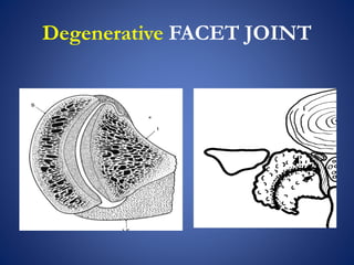 Degenerative FACET JOINT
 