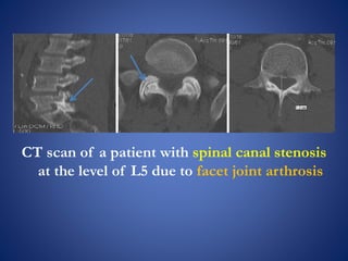 CT scan of a patient with spinal canal stenosis
at the level of L5 due to facet joint arthrosis
 