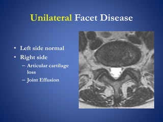 Unilateral Facet Disease
• Left side normal
• Right side
– Articular cartilage
loss
– Joint Effusion
 