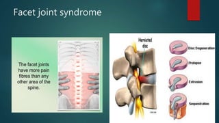 Facet joint syndrome
 