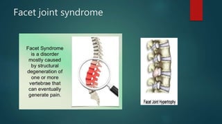 Facet joint syndrome
 