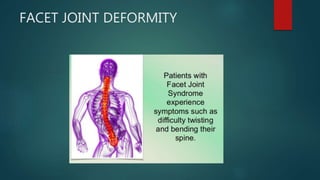 FACET JOINT DEFORMITY
 