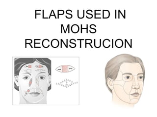 FLAPS USED IN
MOHS
RECONSTRUCION
 