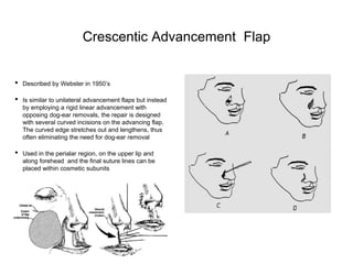 FACIAL.FLAPS.2022.pptx