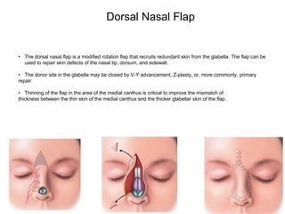 • The dorsal nasal flap is a modified rotation flap that recruits redundant skin from the glabella. The flap can be
used to repair skin defects of the nasal tip, dorsum, and sidewall.
• The donor site in the glabella may be closed by V-Y advancement, Z-plasty, or, more commonly, primary
repair
• Thinning of the flap in the area of the medial canthus is critical to improve the mismatch of
thickness between the thin skin of the medial canthus and the thicker glabellar skin of the flap.
Dorsal Nasal Flap
 