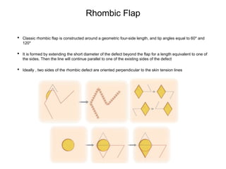 Rhombic Flap
• Classic rhombic flap is constructed around a geometric four-side length, and tip angles equal to 60* and
120*
• It is formed by extending the short diameter of the defect beyond the flap for a length equivalent to one of
the sides. Then the line will continue parallel to one of the existing sides of the defect
• Ideally , two sides of the rhombic defect are oriented perpendicular to the skin tension lines
 