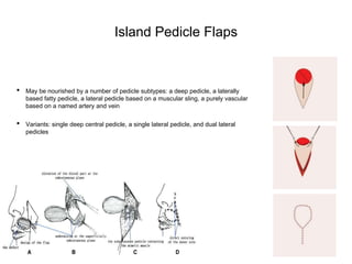 Island Pedicle Flaps
• May be nourished by a number of pedicle subtypes: a deep pedicle, a laterally
based fatty pedicle, a lateral pedicle based on a muscular sling, a purely vascular
based on a named artery and vein
• Variants: single deep central pedicle, a single lateral pedicle, and dual lateral
pedicles
 