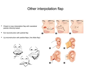 Interposition Flap FACIAL.FLAPS.2022.pptx