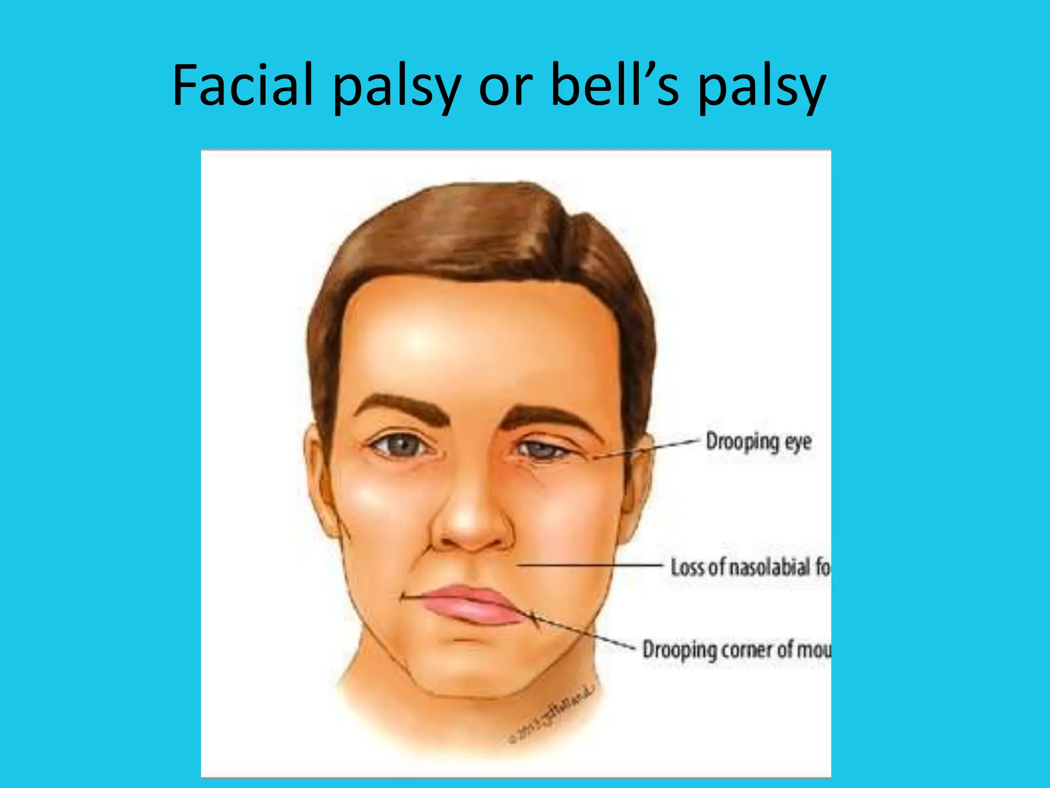  Facial Palsy or Bell s Palsy pptx