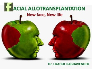 ACIAL ALLOTRANSPLANTATION
Dr. J.RAHUL RAGHAVENDER
 