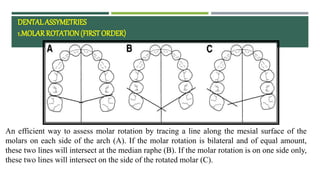 Dental Rotation facial asymmetry ppt management in orthodontics .pptx
