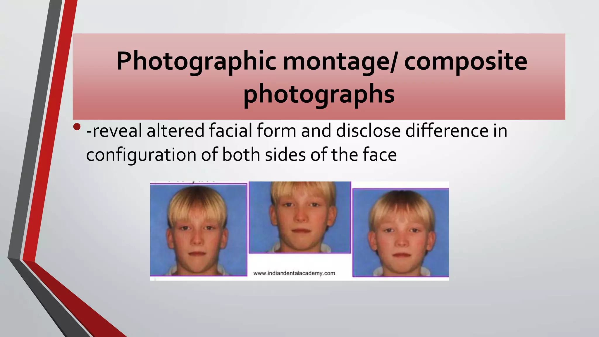 Management of Facial asymmetry | PPTX