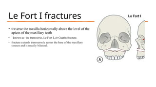 Management of Facial Bone Fracture .pptx