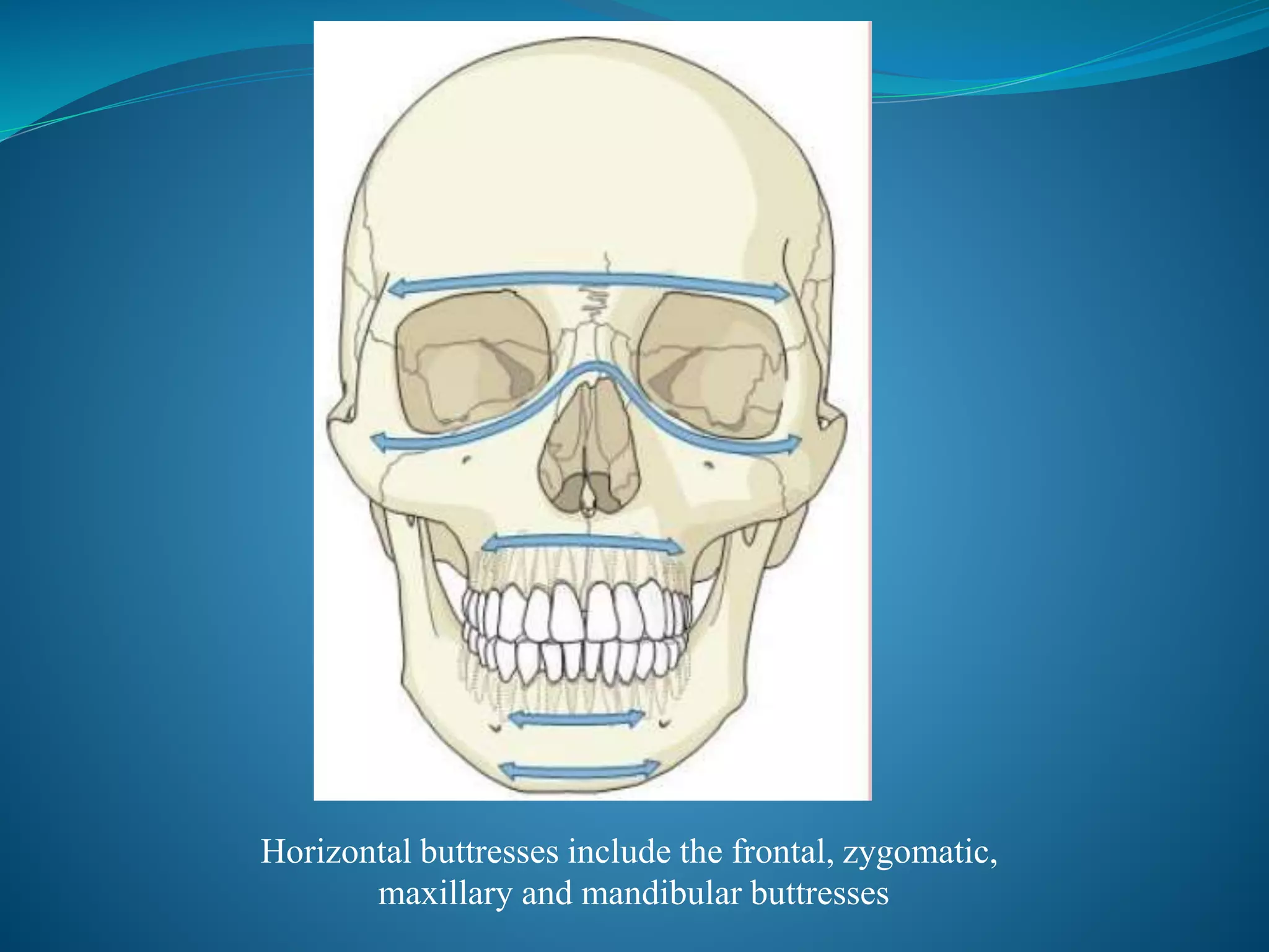 Horizontal buttresses include the frontal, zygomatic,
maxillary and mandibular buttresses
 