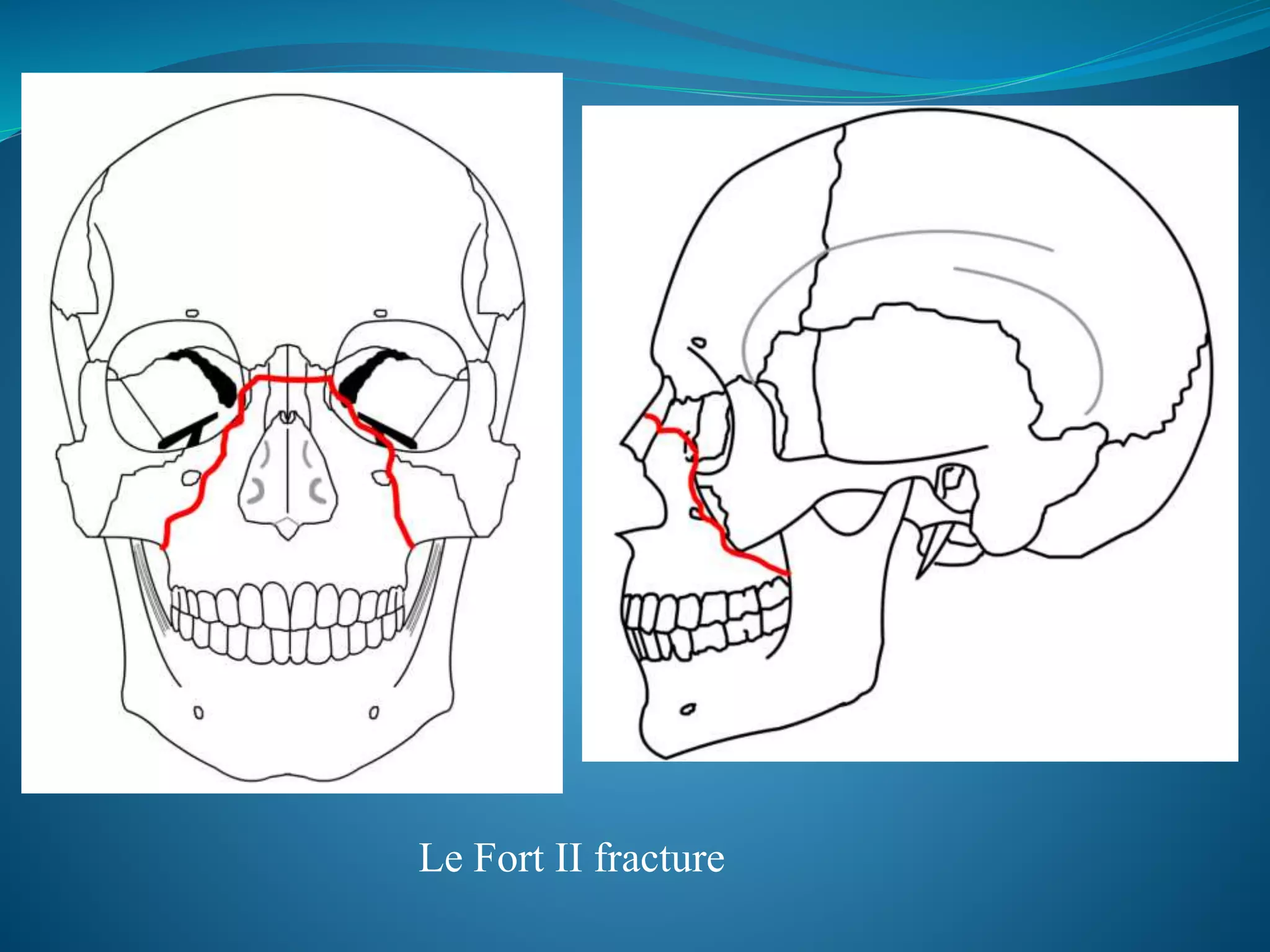 Le Fort II fracture
 