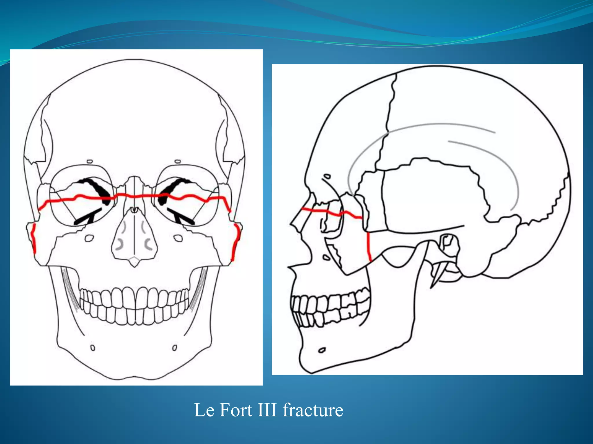 Le Fort III fracture
 