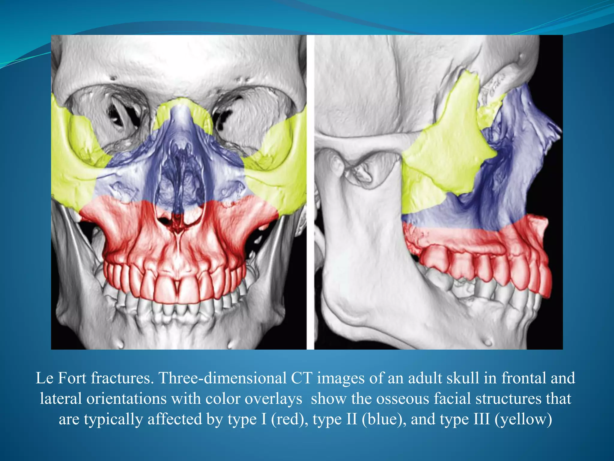 Le Fort fractures. Three-dimensional CT images of an adult skull in frontal and
lateral orientations with color overlays show the osseous facial structures that
are typically affected by type I (red), type II (blue), and type III (yellow)
 