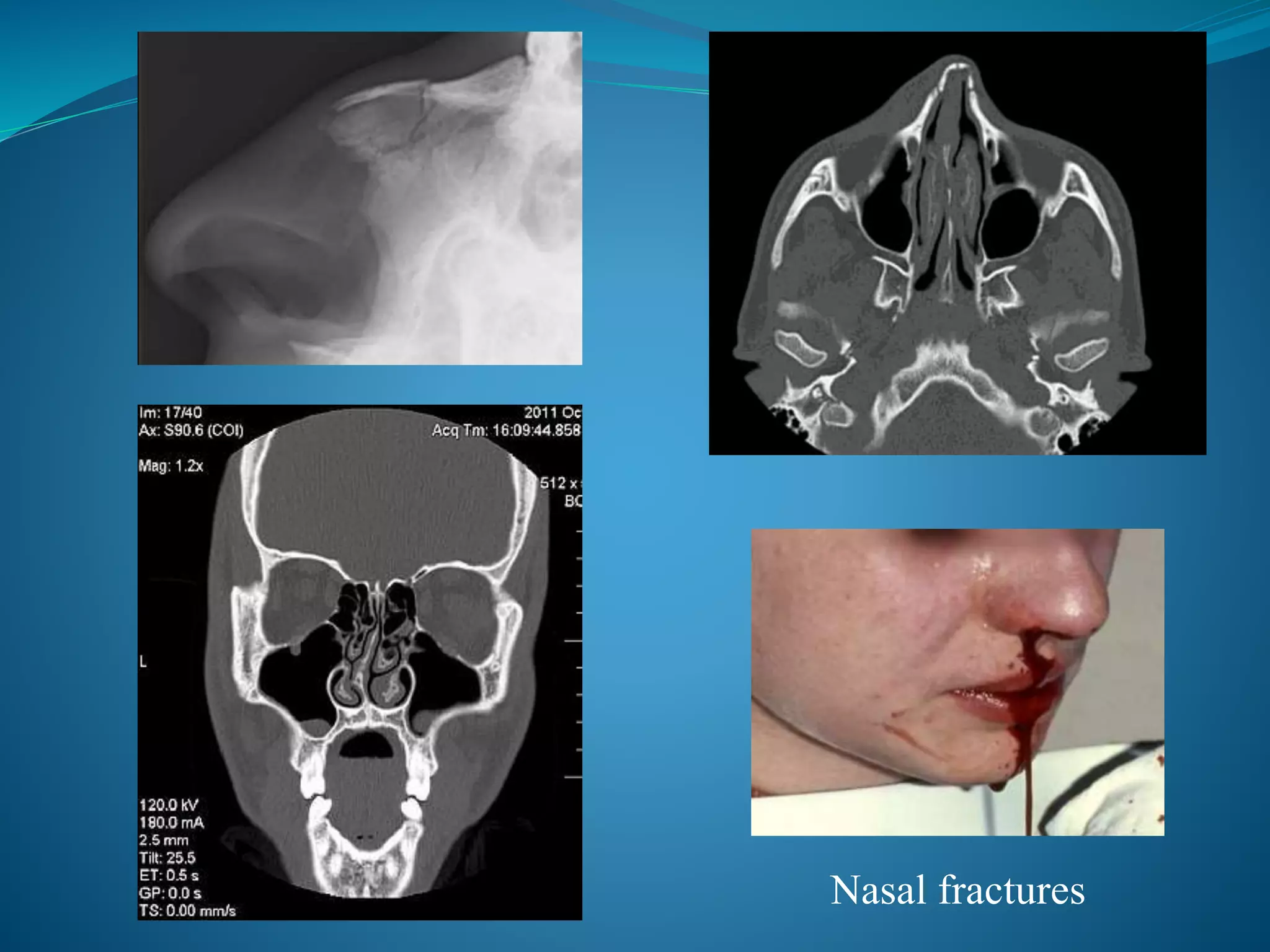 Nasal fractures
 