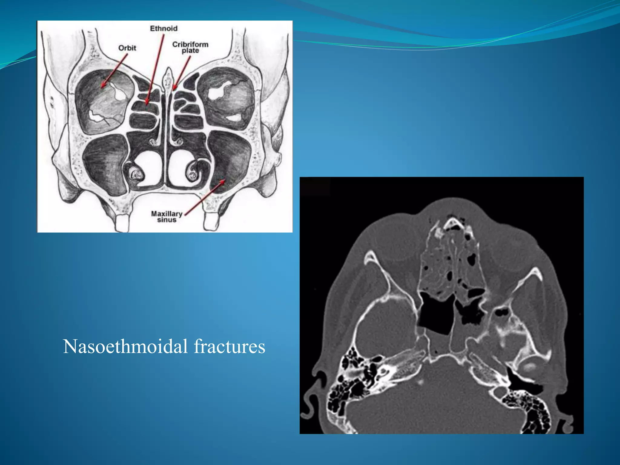Nasoethmoidal fractures
 