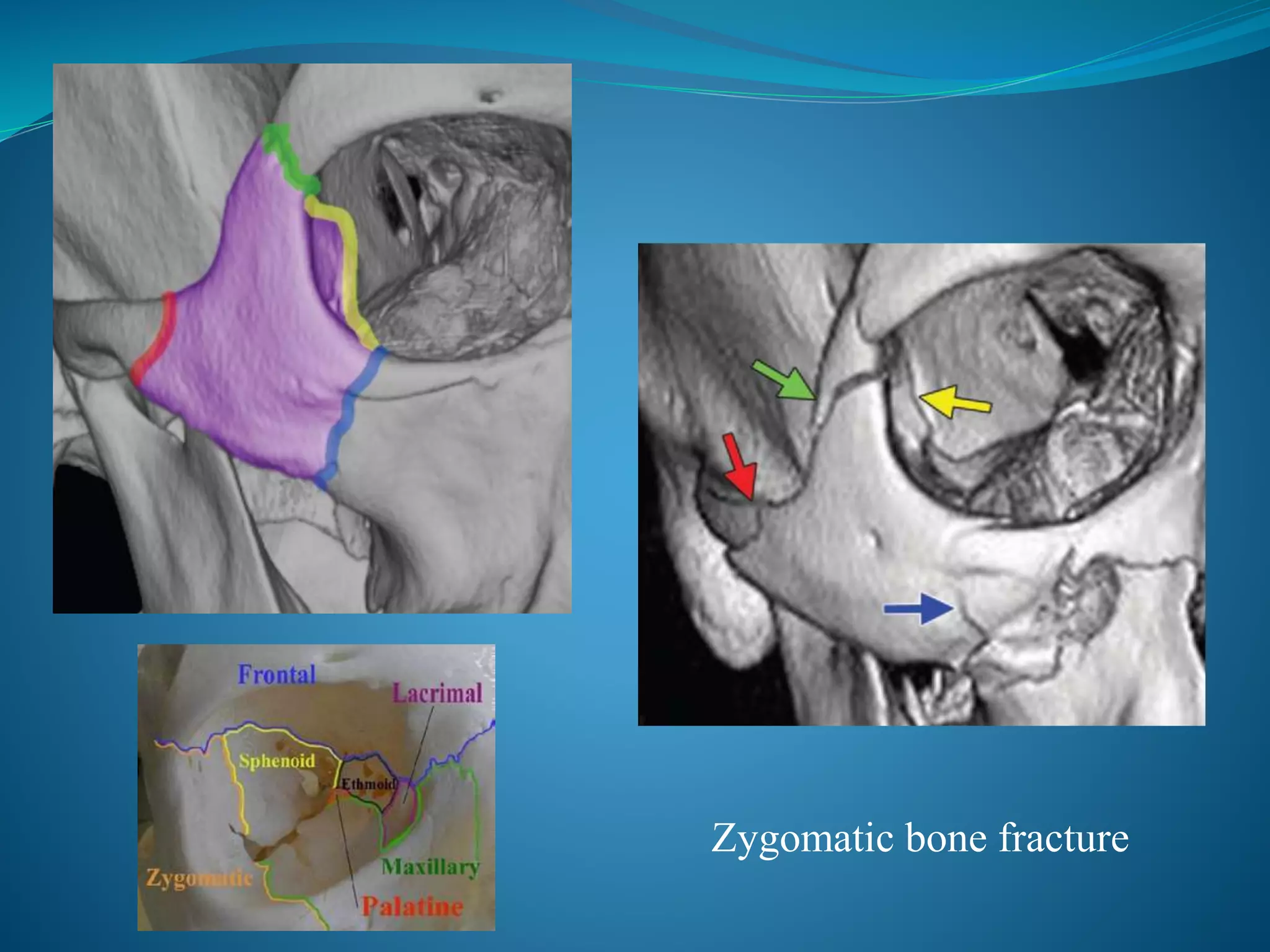 Zygomatic bone fracture
 