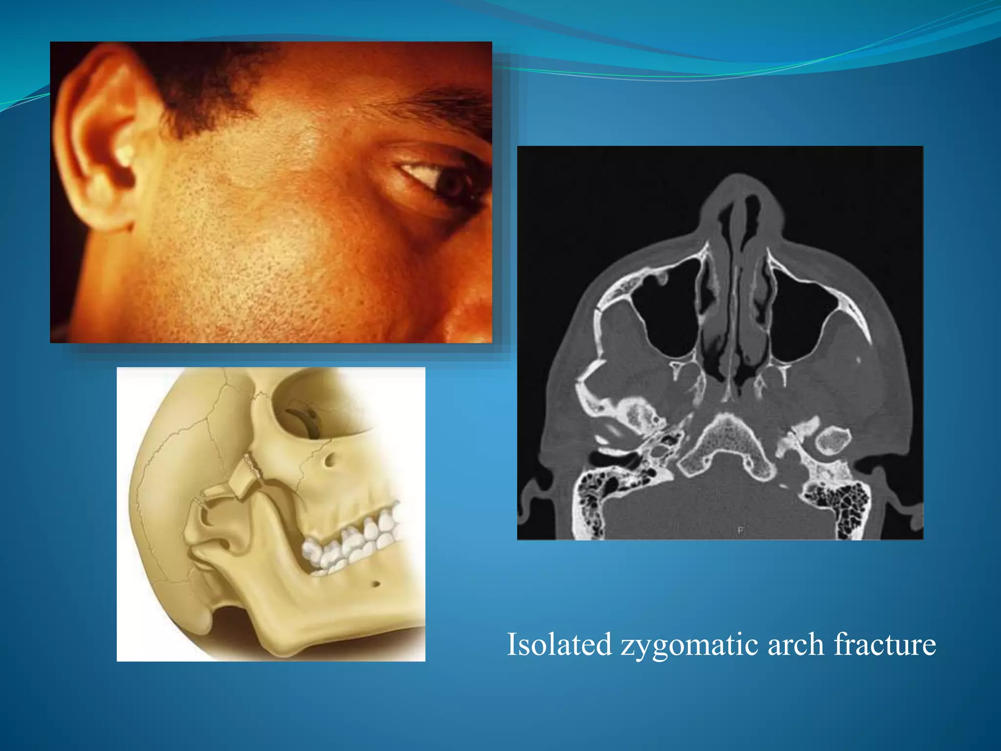 Isolated zygomatic arch fracture
 