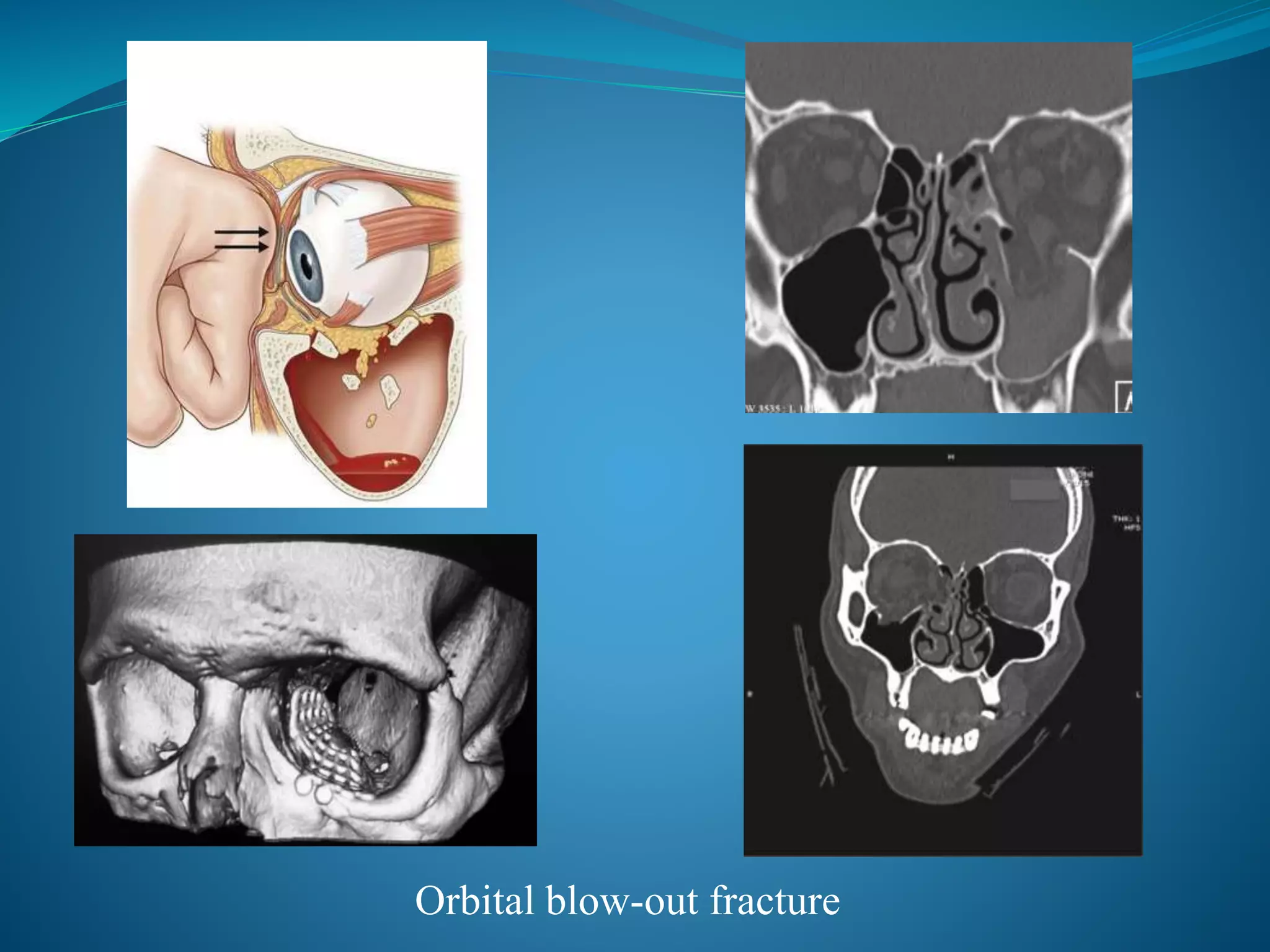 Orbital blow-out fracture
 
