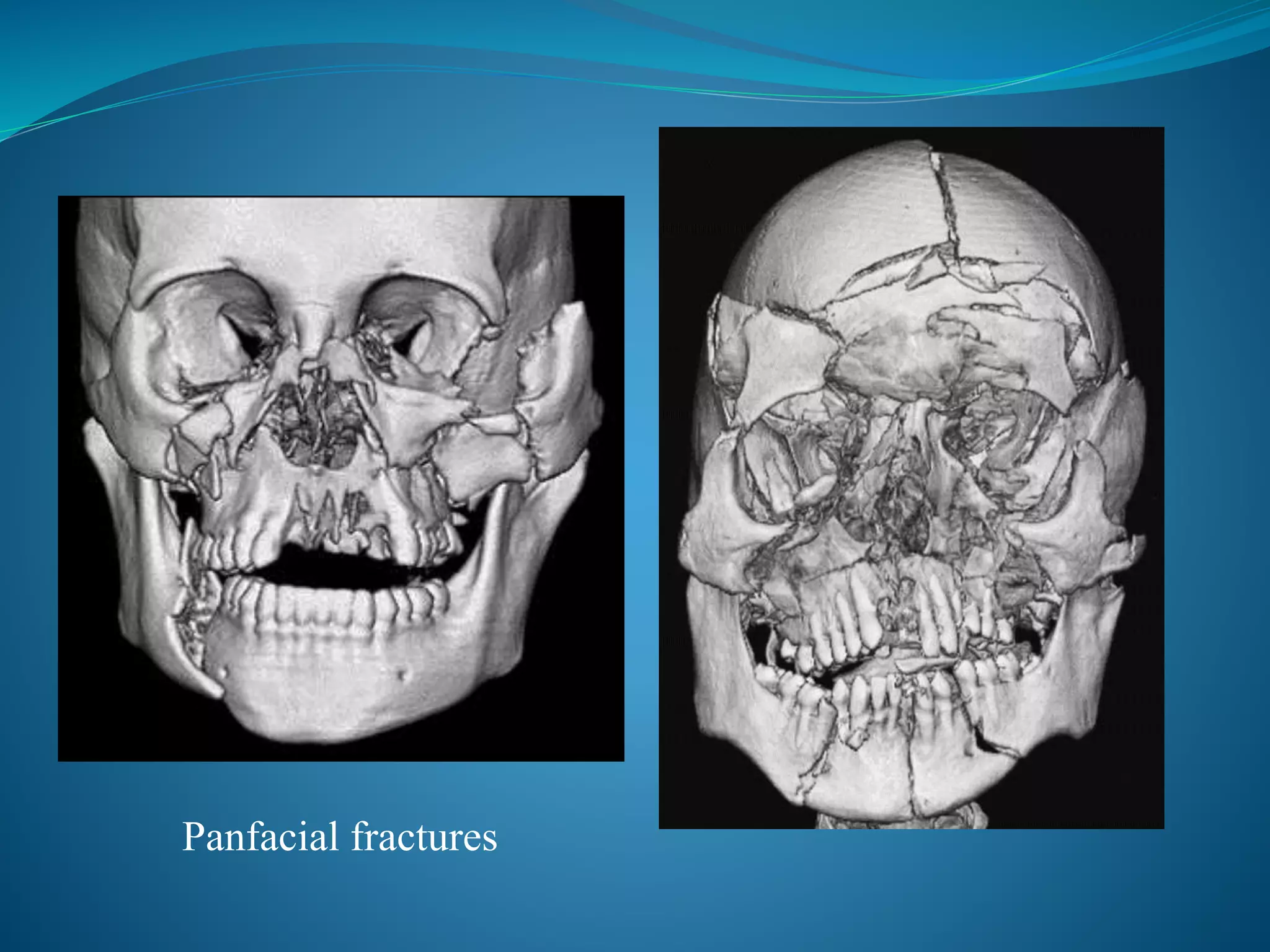 Panfacial fractures
 
