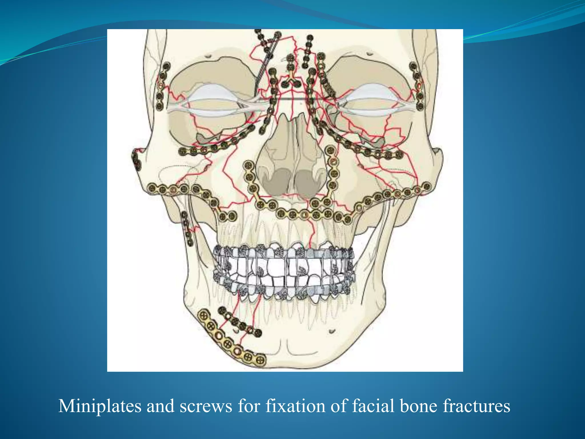 Miniplates and screws for fixation of facial bone fractures
 