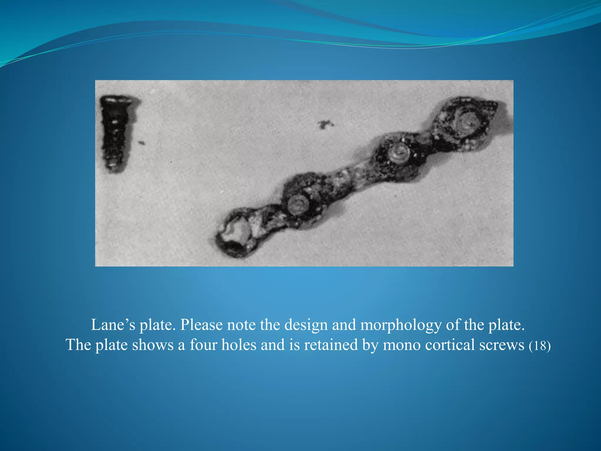 Lane’s plate. Please note the design and morphology of the plate.
The plate shows a four holes and is retained by mono cortical screws (18)
 